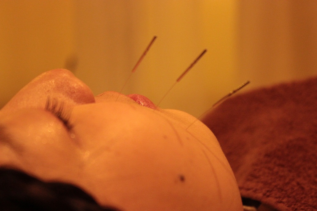 美容鍼灸をホワイトデーにプレゼントしませんか？